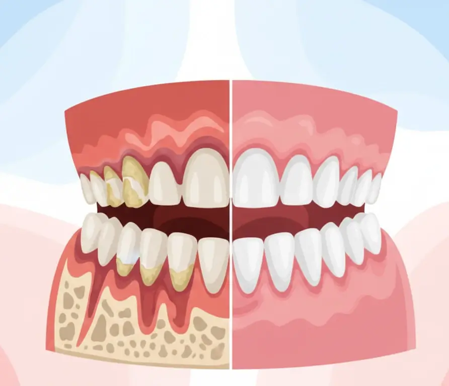 Chiuretaj Radicular – Curățare Profundă Sub Gingie